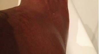 Serena Williams ankle is the size of a grapefruit [photo]
