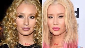 iggy-azalea-nose-chin-job